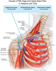 subclavius thoracic contracted subclavian muscles clavicle abnormally hence artery