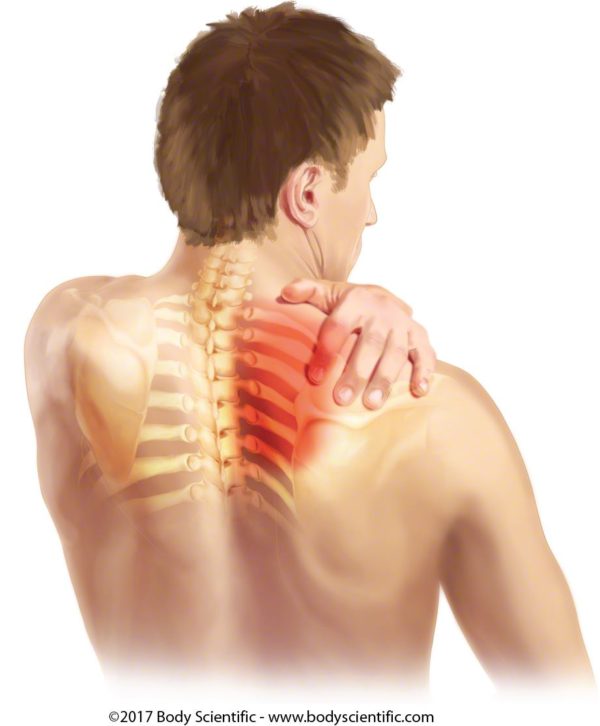 Neck Pain, Upper Back Pain, Shoulder Pain? Could it be Thoracic Outlet