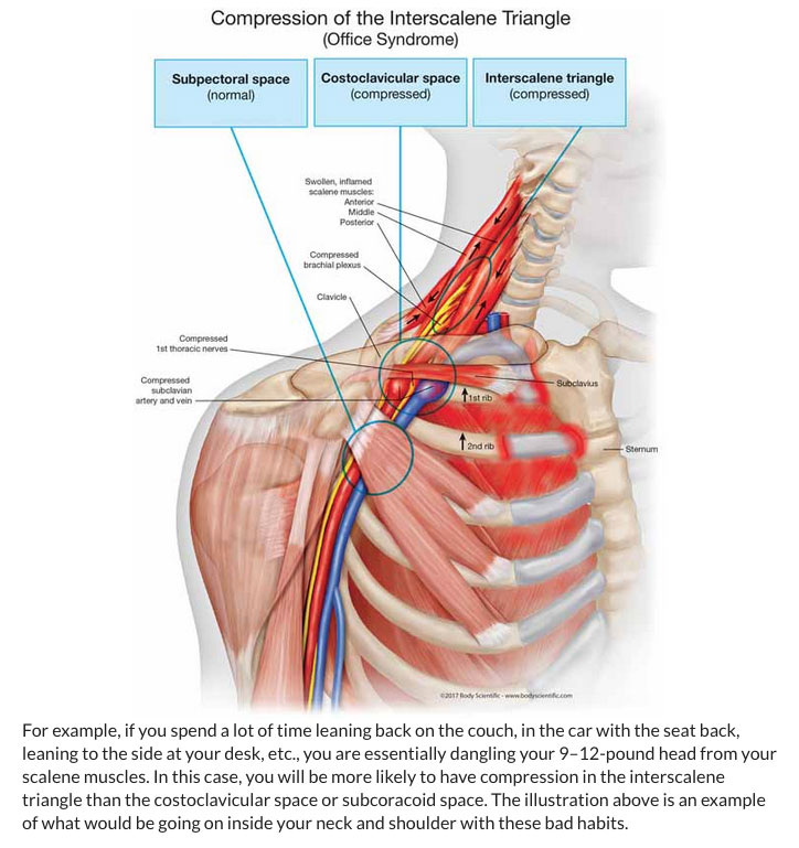 What is TOS? What is Thoracic Outlet Syndrome? by Dr James Stoxen DC.,  FSSEMM (hon) FWSSEM - Thoracic Outlet Syndrome